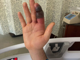 snake bite hackensack meridian health